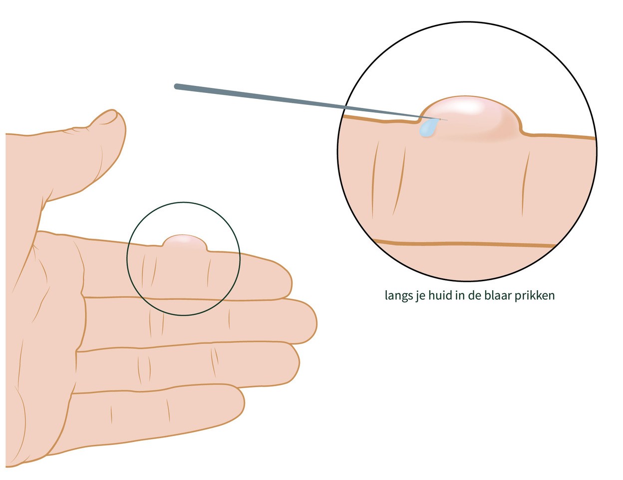 Zo prik je een blaar door: met een speld of naald langs je huid