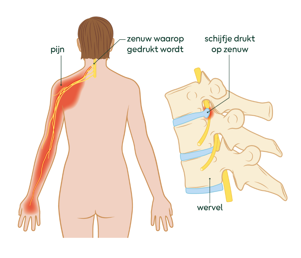 wat is een nek-hernia?