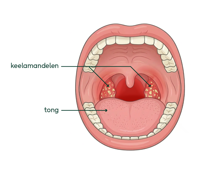 plaatje van ontstoken keel
