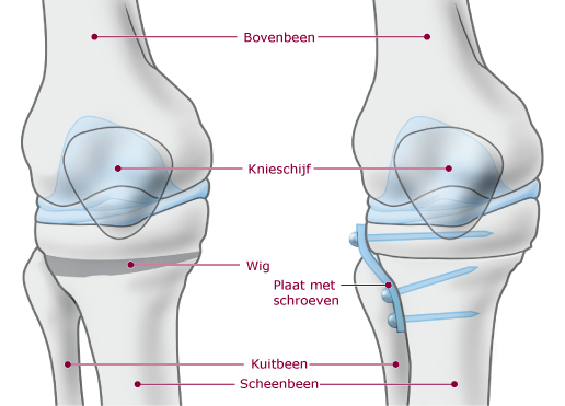 Een tekening van de botten bij de knie en de plaat en schroeven die in de knie zitten na een operatie van de stand van het been