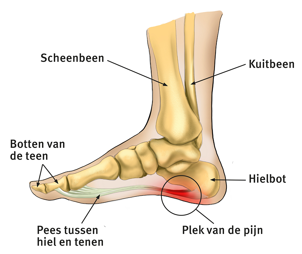 Plaatje van de voet met de plek van de pijn bij hielspoor