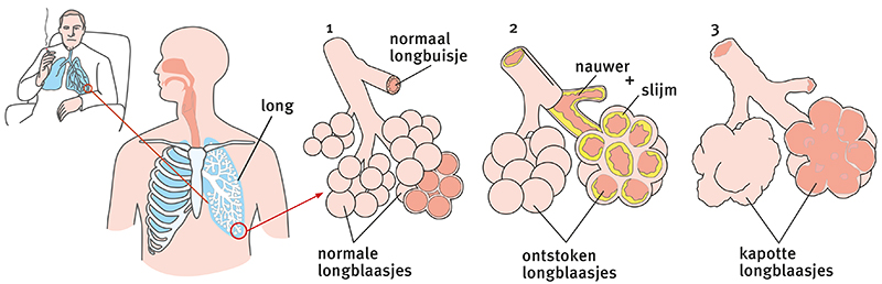 Op de afbeelding staan normale, ontstoken en kapotte longblaasjes bij de longziekte COPD.