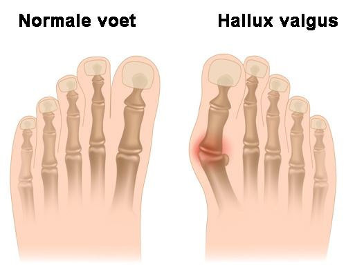 Een normale voet en een voet met een scheve grote teen ofwel hallux valgus