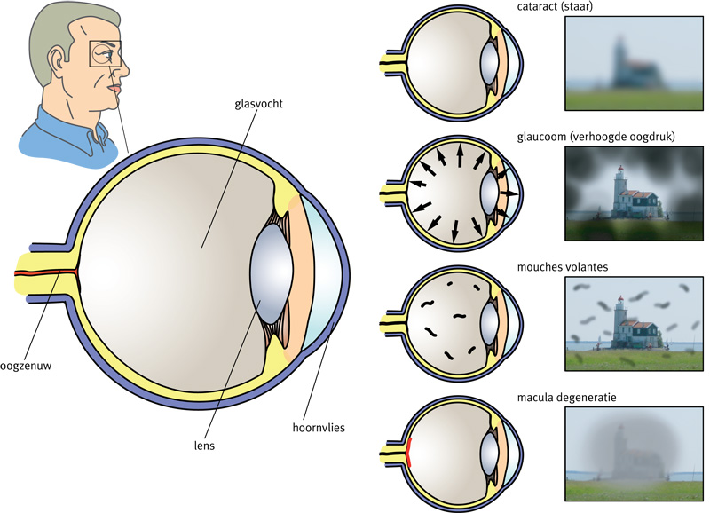 Ik heb mogelijk staar Thuisarts