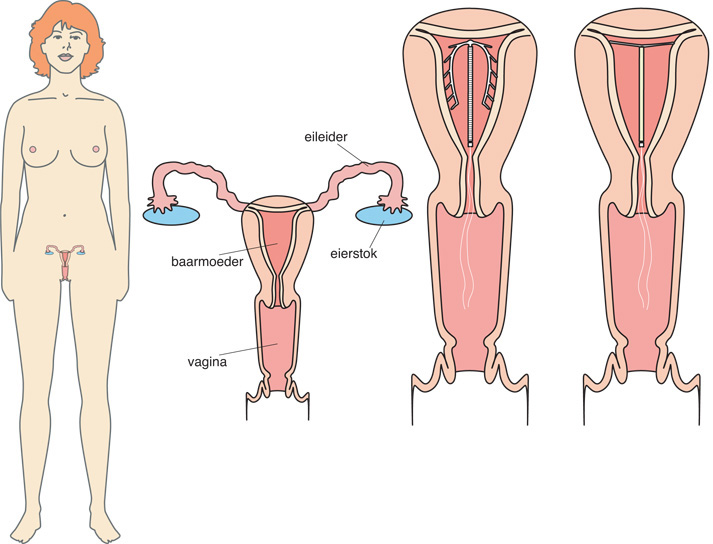 Afbeelding van een spiraal in de baarmoeder