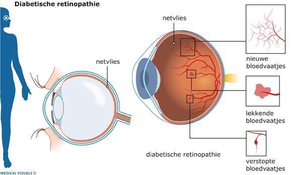 Afbeelding van het netvlies bij diabetische retinopathie