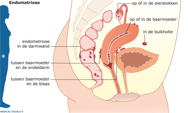 Afbeelding van plekken in de onderbuik waar endometriose kan voorkomen