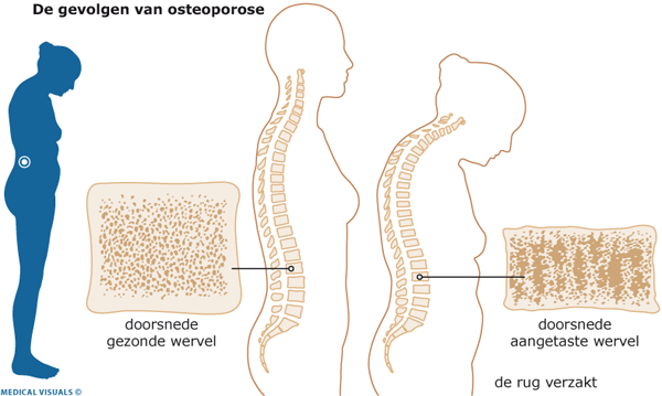 Afbeelding van osteoporose in een wervel