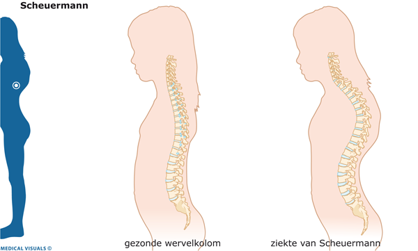 Afbeelding van de rug bij de ziekte van Scheuermann