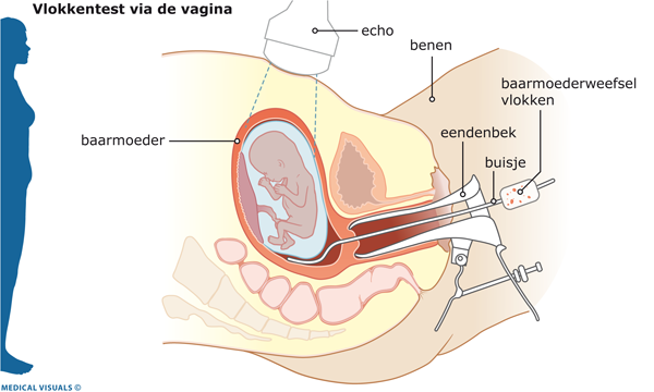 Afbeelding van een vlokkentest via de vagina
