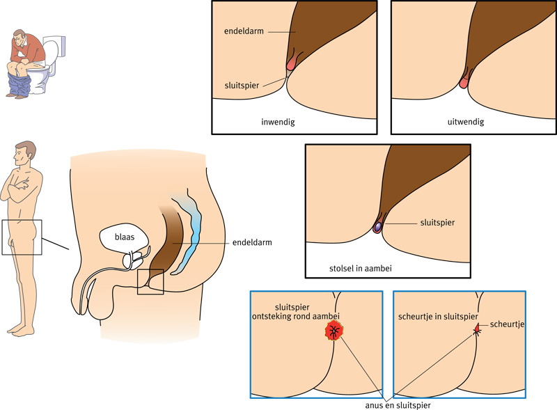 Afbeelding van aambeien en van een scheurtje in de anus