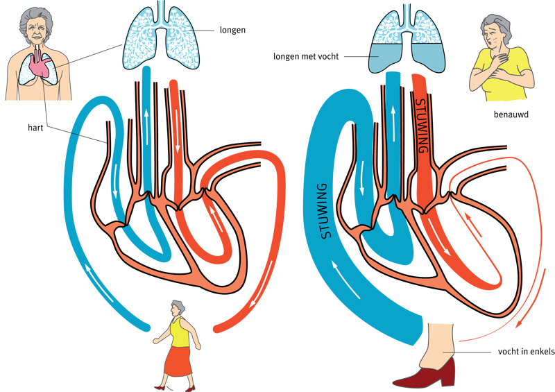 Afbeelding van hartfalen en vocht in de longen