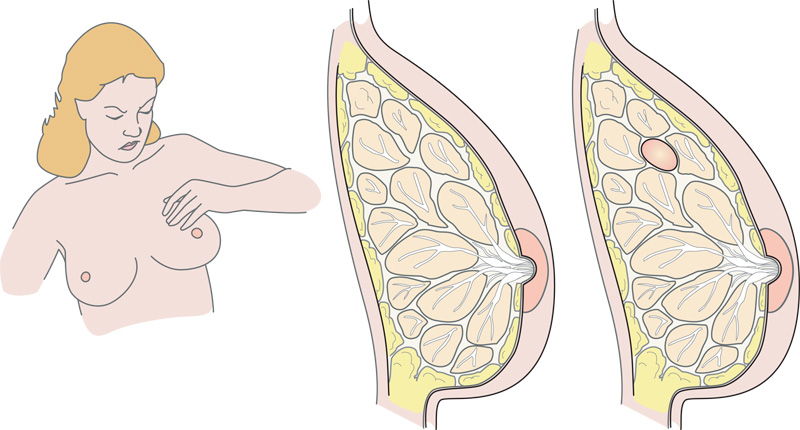 Afbeelding van de binnenkant van de borst bij mastopathie