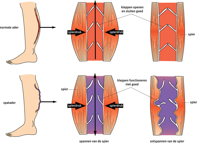 Afbeelding van de kuitspier rond een normale ader en rond een spatader in het been, met een dwarsdoorsnede van de kleppen in een normale ader en in een spatader.n spadkleppen in de normale en in een en en rond een spatader in het been