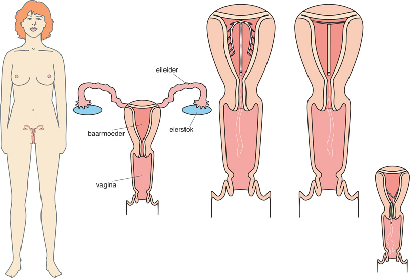 Afbeelding van een spiraaltje in de baarmoeder. Daarnaast een afbeelding van een spiraaltje dat niet goed op zijn plaats zit.