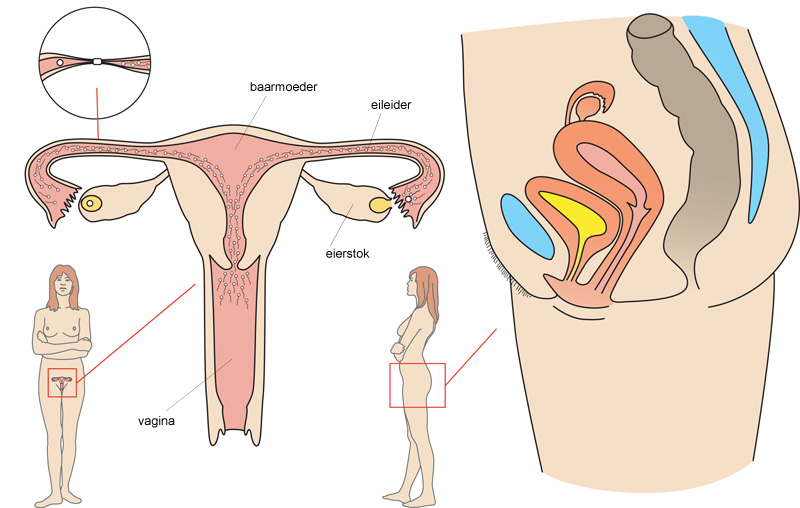 Afbeelding van sterilisatie bij de vrouw