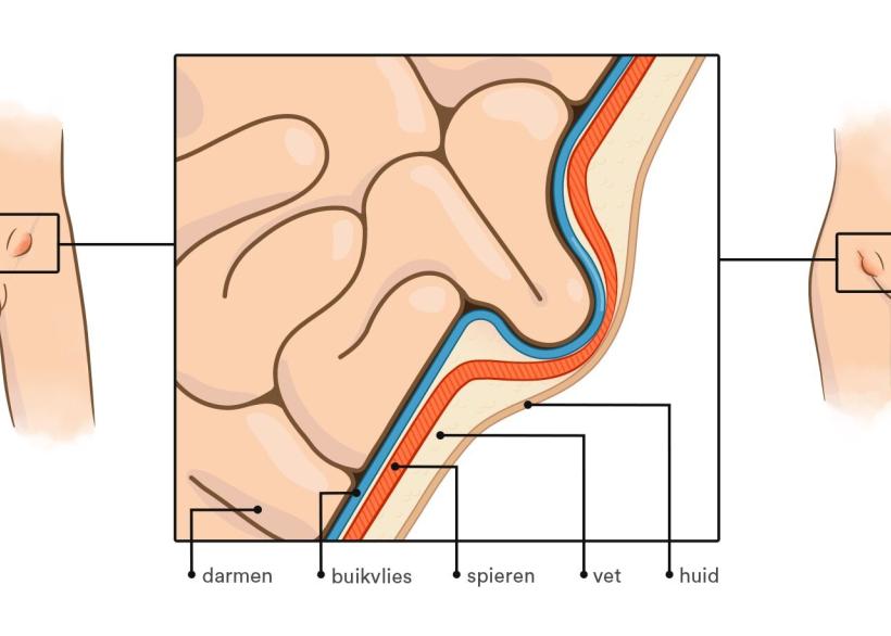Tekening van een liesbreuk