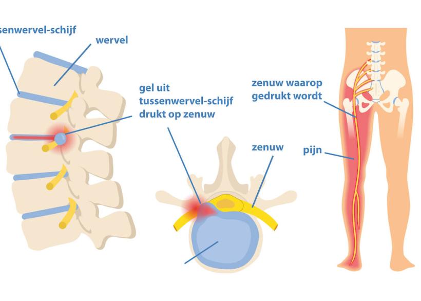Hernia in je rug: afbeelding van de tussenwervel-schijf die op een zenuw drukt en pijn geeft