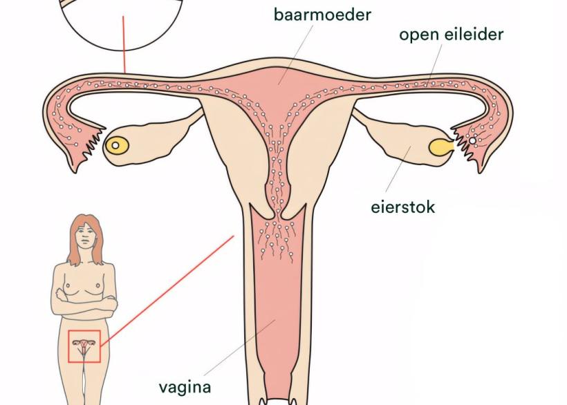 Afbeelding van baarmoeder, eileiders en eierstokken en de plek waar een eileider wordt dichtgemaakt bij sterilisatie