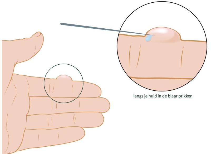 Zo prik je een blaar door: met een speld of naald langs je huid