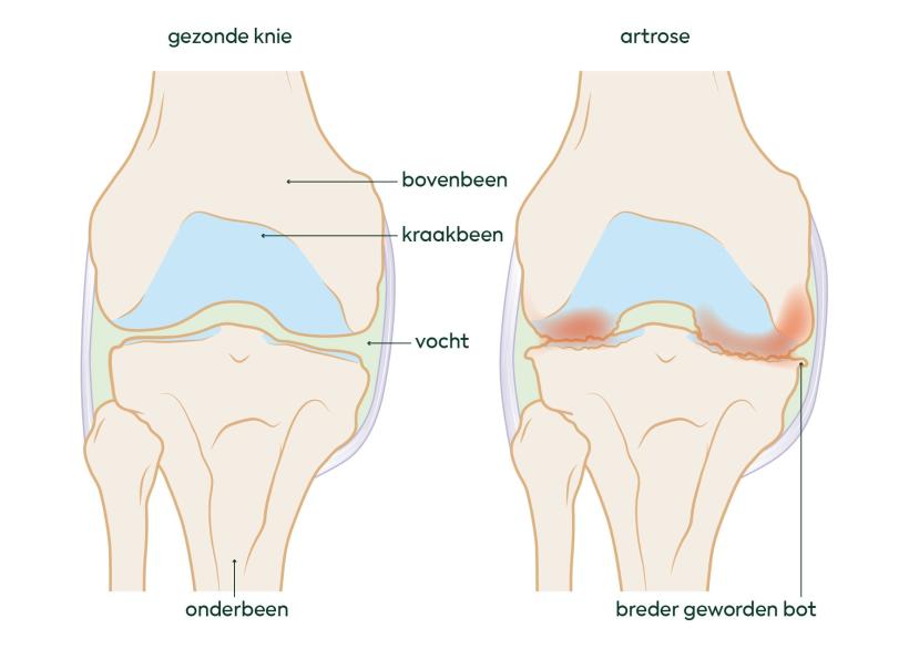 artrose in knie