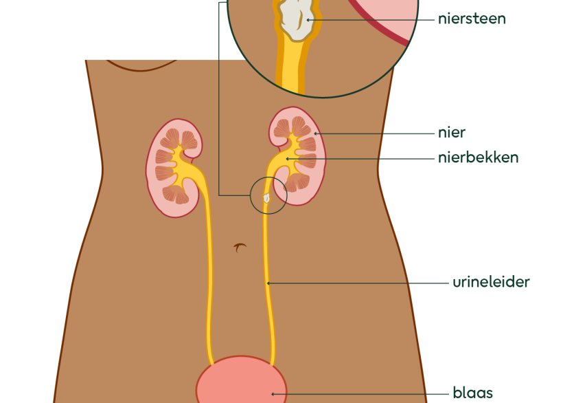 Illustratie van nieren, urineleiders en blaas met een niersteen in de urineleider