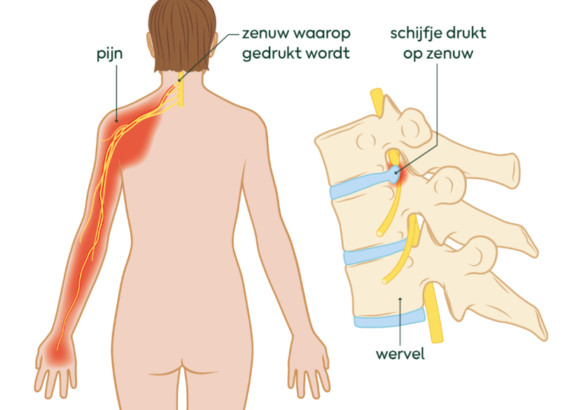 wat is een nek-hernia?