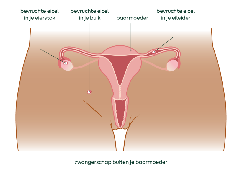 Tekening van een zwangerschap buiten de baarmoeder met de bevruchte eicel op een andere plek dan in de baarmoeder