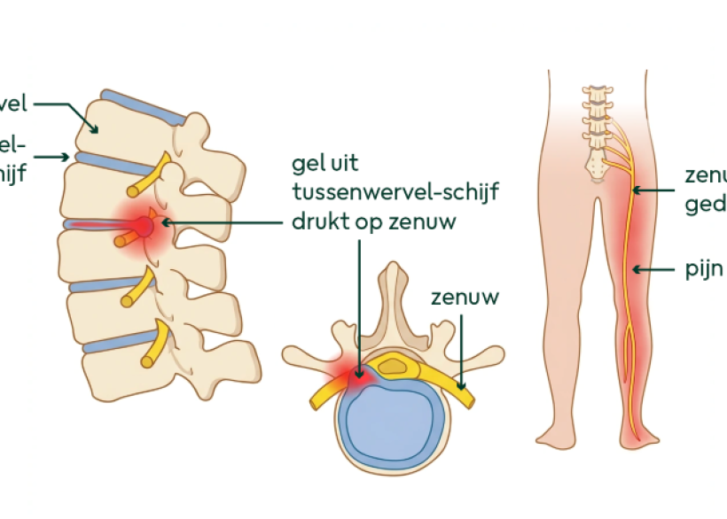 Afbeelding van de tussenwervel-schijf die op een zenuw drukt en pijn geeft