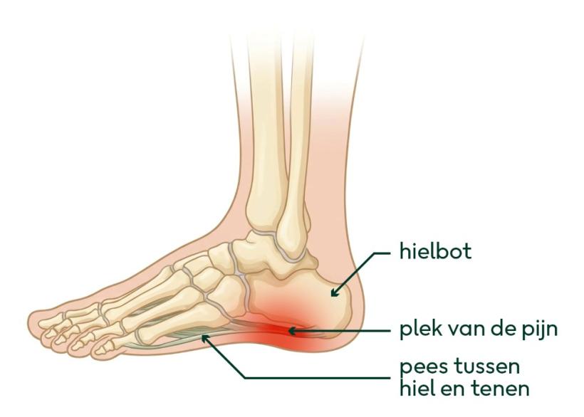Tekening van hielspoor onder je voet. De pijn zit op de plek waar je pees vastzit aan de onderkant van je hiel.