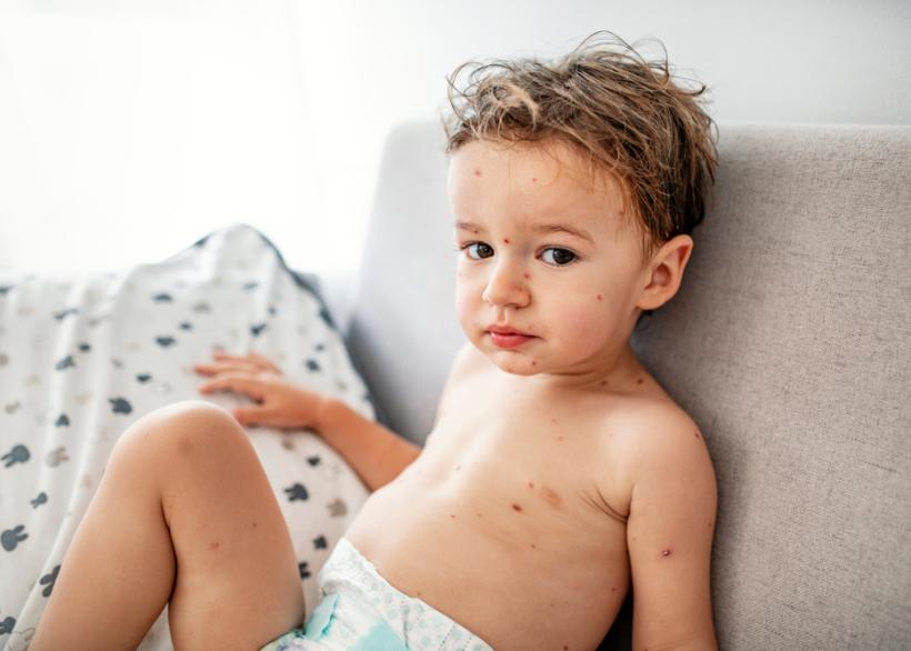 Een klein kind met waterpokken