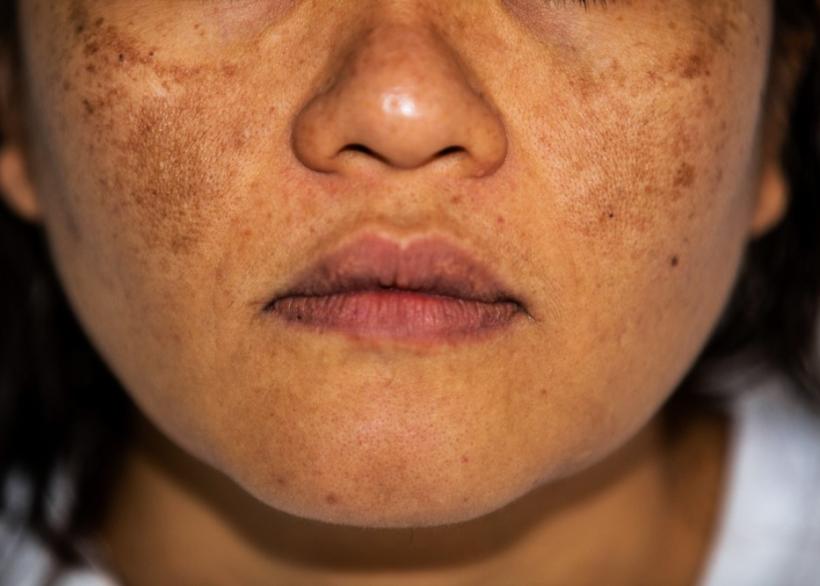 Vrouw met bruine vlekken in het gezicht