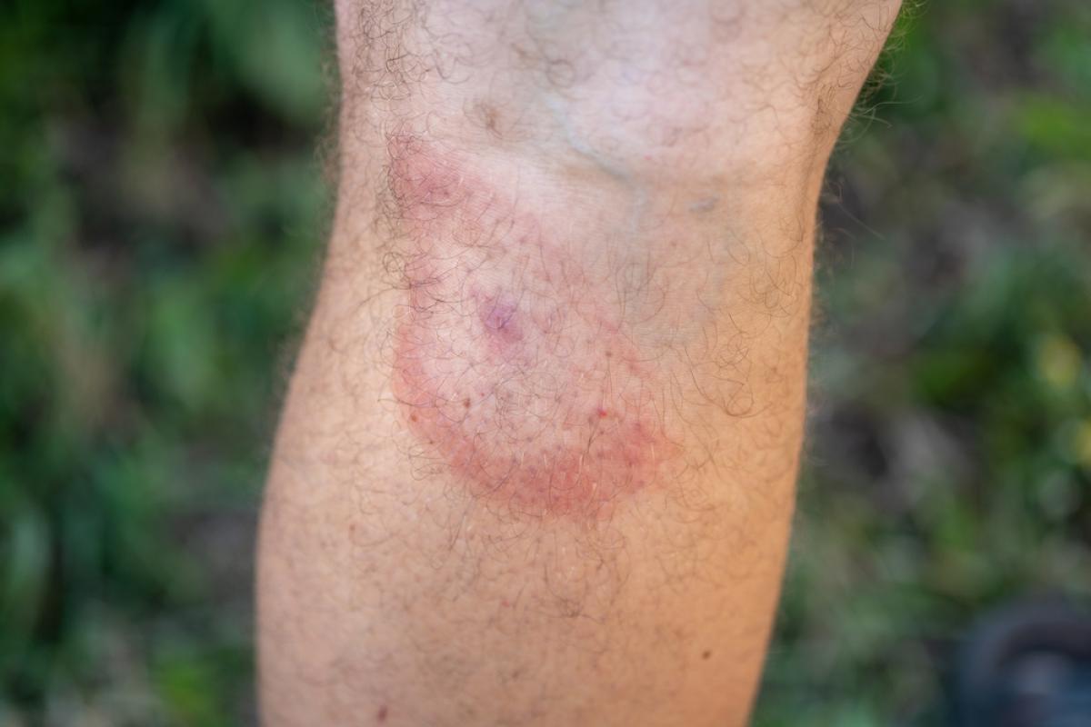 Huid met rode ring rond een tekenbeet