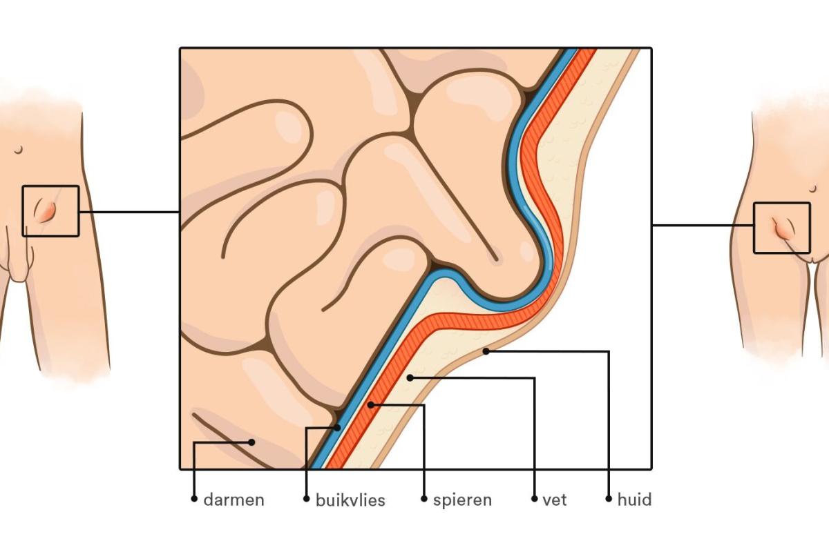 Tekening van een liesbreuk