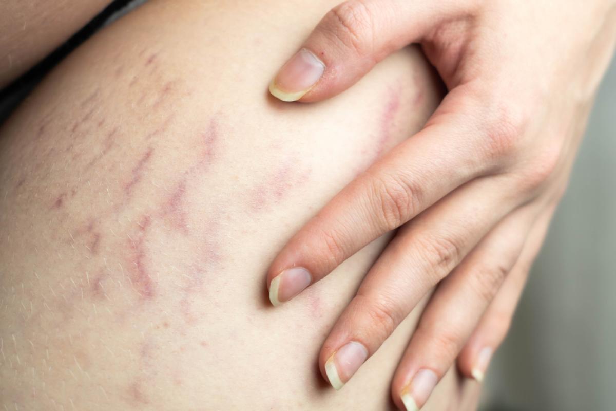 nieuwe striae op het bovenbeen bij een lichte huid