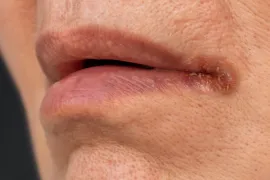 Kapotte mondhoek van dichtbij