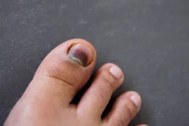 blauwe nagel bij grote teen