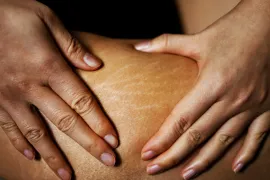 oudere striae bij een donkere huid