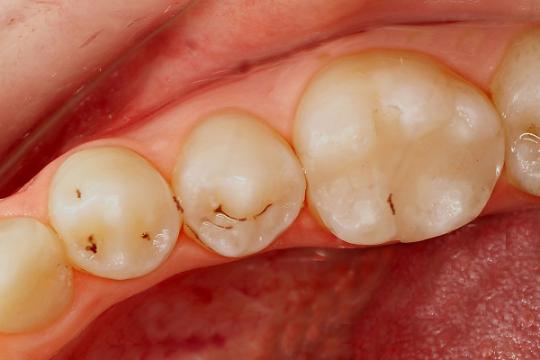 Ik Heb Last Van Tandbederf Thuisarts